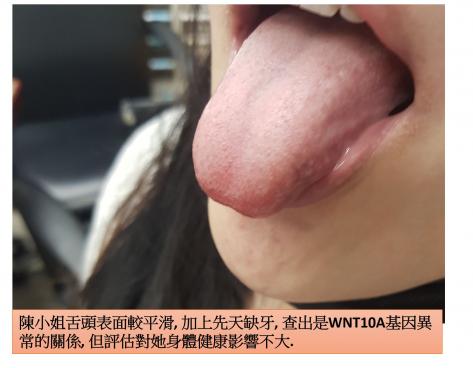 WNT10A基因異常造成的先天缺牙