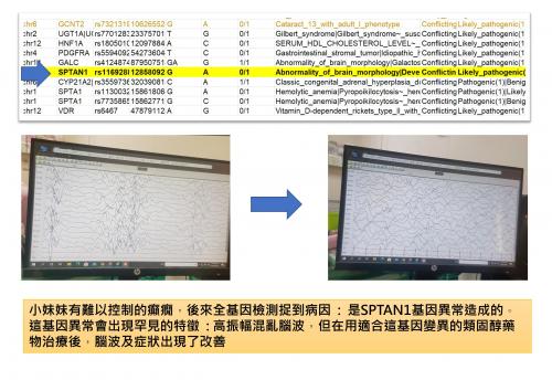 SPTAN1基因異常造成的發育性癲癇性腦病變