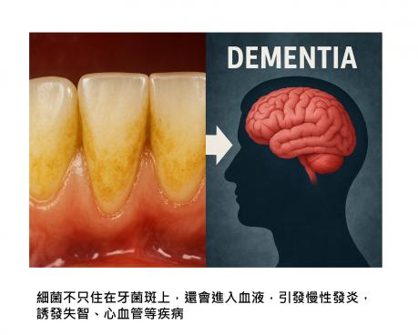 以為只是牙垢？牙菌斑其實是全身慢性病的溫床