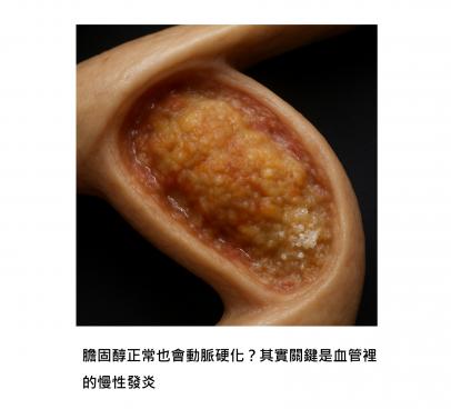 不只是膽固醇的問題，而是慢性發炎讓免疫系統亂掉了：揭開動脈粥樣硬化的細胞內幕