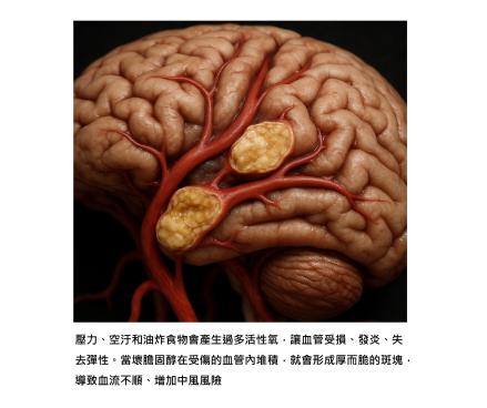 腦動脈粥樣硬化 - 血管老化的隱形危機