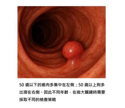 大腸瘜肉的「年齡分布密碼」 : 50 歲以下偏左側,而 50 歲以上偏右側,帶您看懂分子機制與真正的預防對策