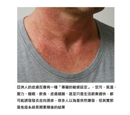 不是皮膚比較敏感, 是免疫比較「緊張」– 了解亞洲人特有的濕疹體質