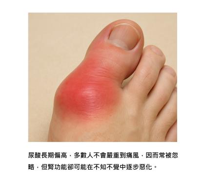 尿酸高沒症狀要注意嗎 ? 這其實是身體發出的傷腎訊號