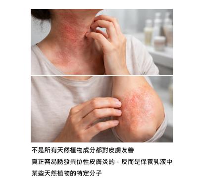 皮膚不是在鬧脾氣 – 原來接觸性皮膚炎一直好不了，是因為我們沒聽懂它