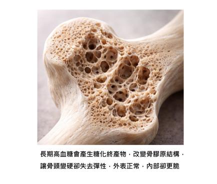 骨密度正常，為什麼還是會骨折？骨頭變硬卻更脆，糖尿病族群常被忽略的風險